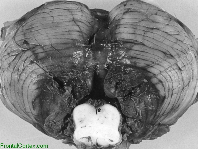 Hemorrhagic necrosis, cerebellar tonsils, inferior surface including medulla.
